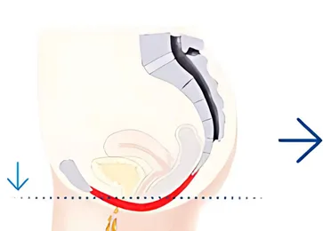 Before EMSELLA Pelvic Floor Conditioning Treatment