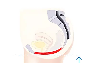After EMSELLA Pelvic Floor Conditioning Treatment