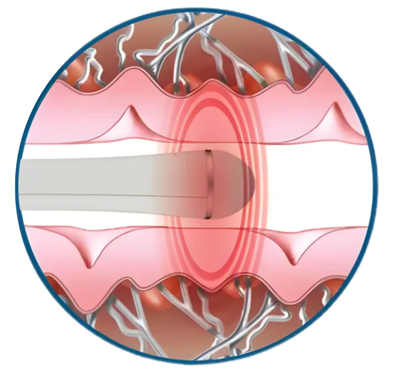 Treatment Demo - EMFEMME Vaginal Rejuvenation Treatment