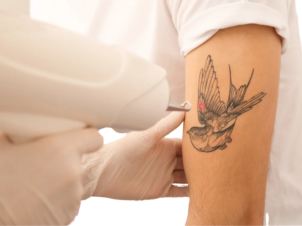 Spectrum Laser Tattoo Removal - Vigeo Care Center & Aesthetics In Algonquin IL