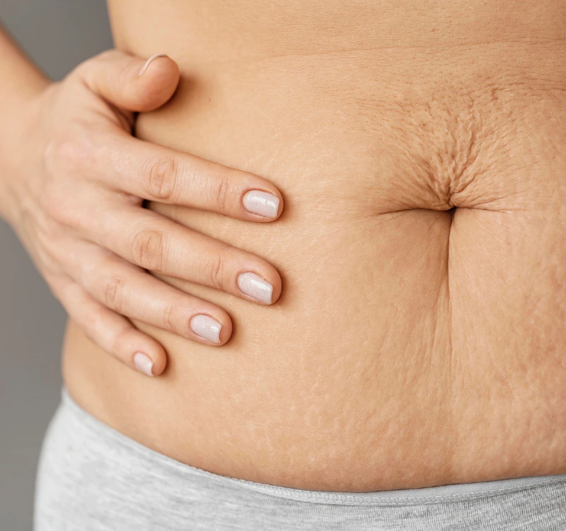 Stretch Marks (Striae) Treatment - Vigeo Care Center & Aesthetics In Algonquin IL