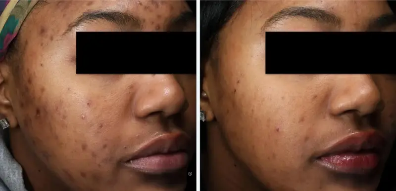 Face Acne Treatment - Aerolase Laser Services - Vigeo Care Center & Aesthetics In Algonquin IL