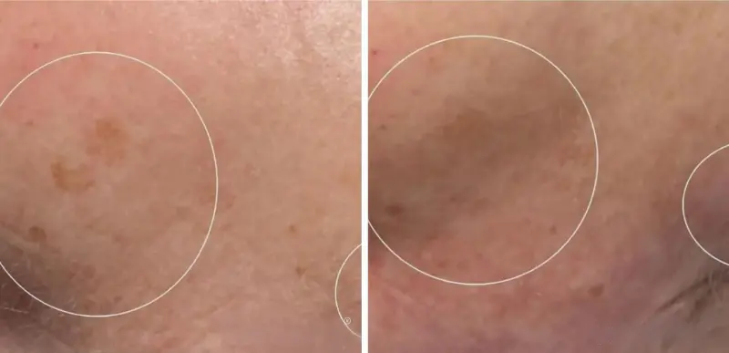 Cheek Anti-Aging & Rejuvenation Treatments - Aerolase Laser Services - Vigeo Care Center & Aesthetics In Algonquin IL