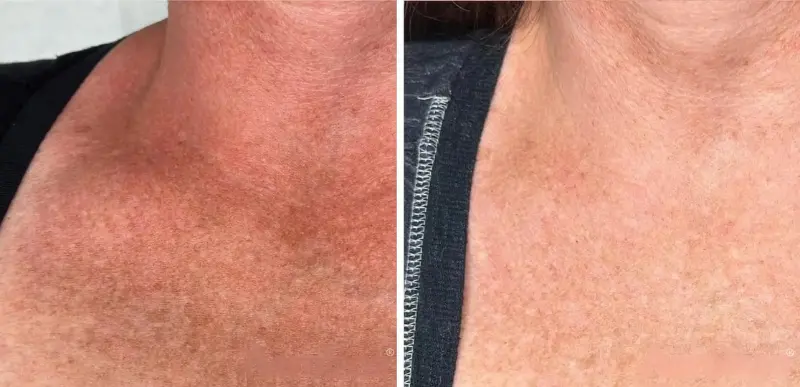 Neck Anti-Aging & Rejuvenation Treatments - Aerolase Laser Services - Vigeo Care Center & Aesthetics In Algonquin IL