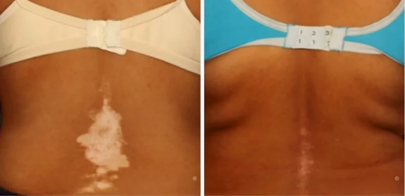 Back - Autoimmune & Chronic Skin Disorder Treatments - Aerolase Laser Services - Vigeo Care Center & Aesthetics In Algonquin IL