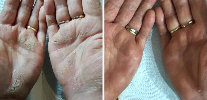 Autoimmune & Chronic Skin Disorder Treatments - Aerolase Laser Services - Vigeo Care Center & Aesthetics In Algonquin IL