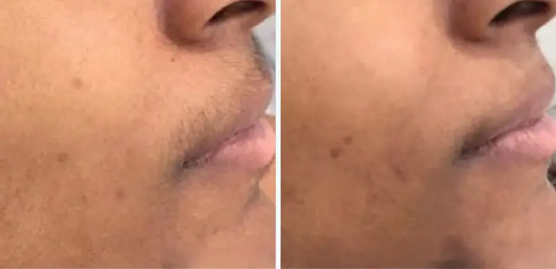 Hair Removal Treatment 1- Aerolase Laser Services - Vigeo Care Center & Aesthetics In Algonquin IL