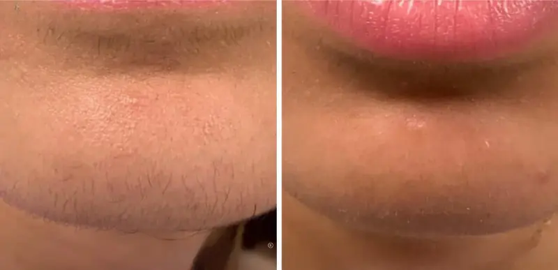 Hair Removal Treatment 3- Aerolase Laser Services - Vigeo Care Center & Aesthetics In Algonquin IL