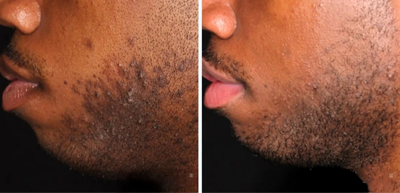 Melasma Treatment - Aerolase Laser Services - Vigeo Care Center & Aesthetics In Algonquin IL