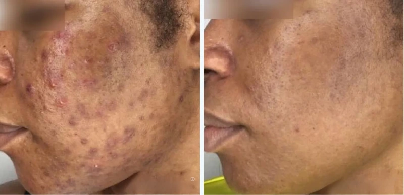 Melasma & Hyperpigmentation Treatment - Aerolase Laser Services - Vigeo Care Center & Aesthetics In Algonquin IL