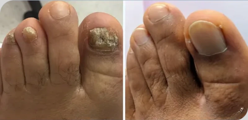 Nail & Foot Condition Treatments - Aerolase Laser Services - Vigeo Care Center & Aesthetics In Algonquin IL