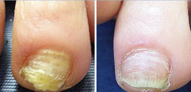 Yellow Nail Condition Treatments - Aerolase Laser Services - Vigeo Care Center & Aesthetics In Algonquin IL