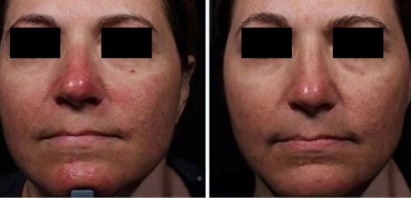 Rosacea & Inflammatory Skin Conditions Treatment - Aerolase Laser Services - Vigeo Care Center & Aesthetics In Algonquin IL