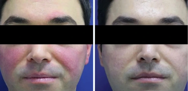 Face - Rosacea & Inflammatory Skin Conditions Treatment - Aerolase Laser Services - Vigeo Care Center & Aesthetics In Algonquin IL
