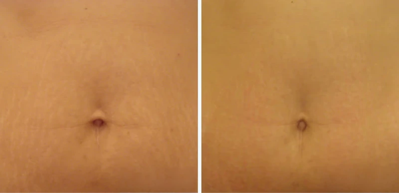 Stretchmark Treatments - Aerolase Laser Services - Vigeo Care Center & Aesthetics In Algonquin IL