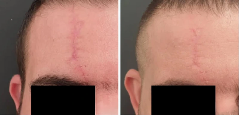 Scars & Stretch Mark Treatments - Aerolase Laser Services - Vigeo Care Center & Aesthetics In Algonquin IL