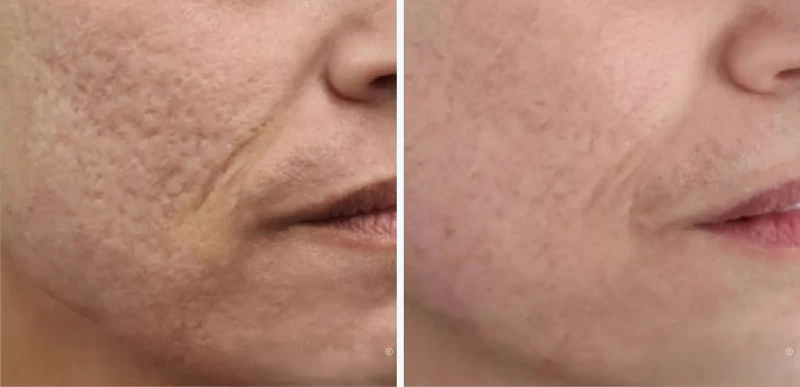 Face Scars Treatments - Aerolase Laser Services - Vigeo Care Center & Aesthetics In Algonquin IL