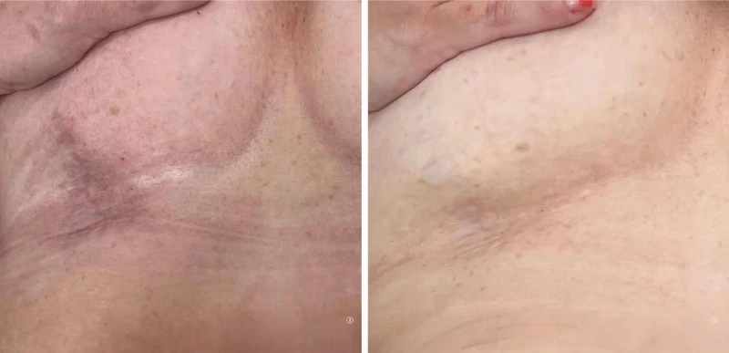 body Scars Treatments - Aerolase Laser Services - Vigeo Care Center & Aesthetics In Algonquin IL