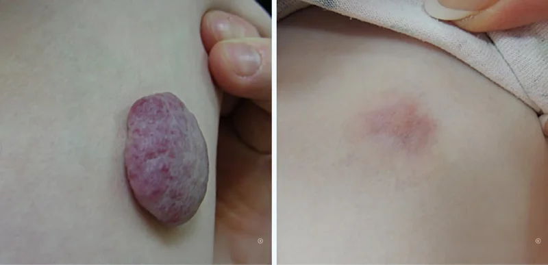 Vascular Lesions Treatment - Aerolase Laser Services - Vigeo Care Center & Aesthetics In Algonquin IL