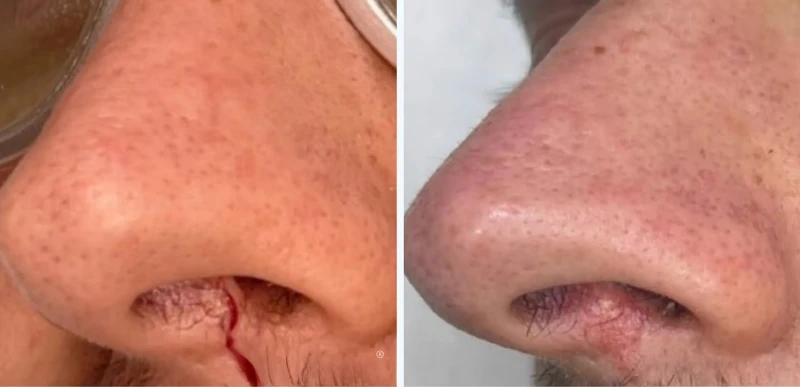 Nose Vascular Lesions Treatment - Aerolase Laser Services - Vigeo Care Center & Aesthetics In Algonquin IL