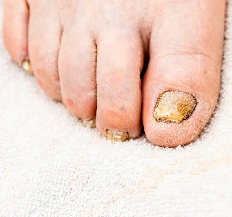 Ideal Candidate Aerolase Nail & Foot Condition Treatments - Vigeo Care Center & Aesthetics In Algonquin IL