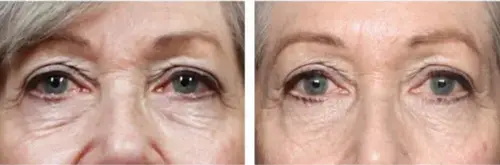 wrinkles before and after Exion RF Microneedling - Vigeo Care Center & Aesthetics In Algonquin IL