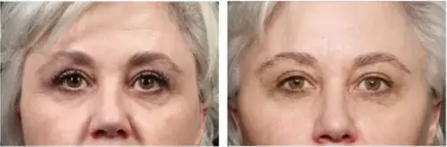 Fine lines before and after Exion RF Microneedling - Vigeo Care Center & Aesthetics In Algonquin IL