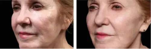 Uneven skin tone and texture before and after Exion RF Microneedling - Vigeo Care Center & Aesthetics In Algonquin IL