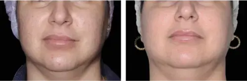 Sagging skin before and after Exion RF Microneedling - Vigeo Care Center & Aesthetics In Algonquin IL