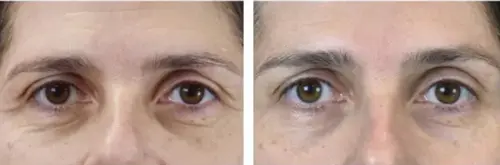 Uneven skin tone and texture before and after Exion RF Microneedling - Vigeo Care Center & Aesthetics In Algonquin IL