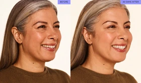 MODERATE TO SEVERE CROW'S FEET LINES - Neurotoxin Services - Vigeo Care Center & Aesthetics in Algonquin IL