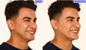 CROW'S FEET LINES - Neurotoxin Services - Vigeo Care Center & Aesthetics in Algonquin IL