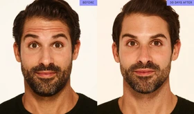 MODERATE TO SEVERE FOREHEAD LINES - Neurotoxin Services - Vigeo Care Center & Aesthetics in Algonquin IL