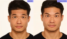 FOREHEAD LINES - Neurotoxin Services - Vigeo Care Center & Aesthetics in Algonquin IL